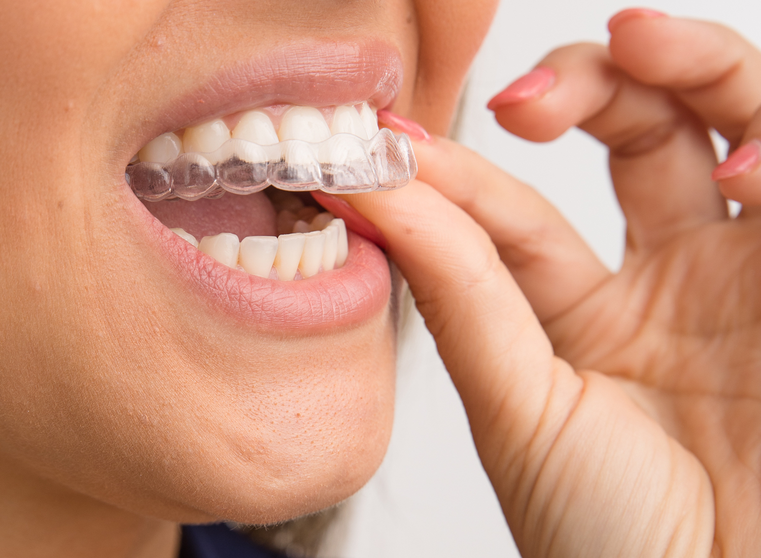 Simple aligners closeup